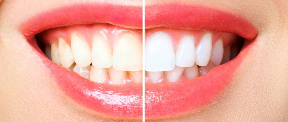 Stains Appear on Teeth