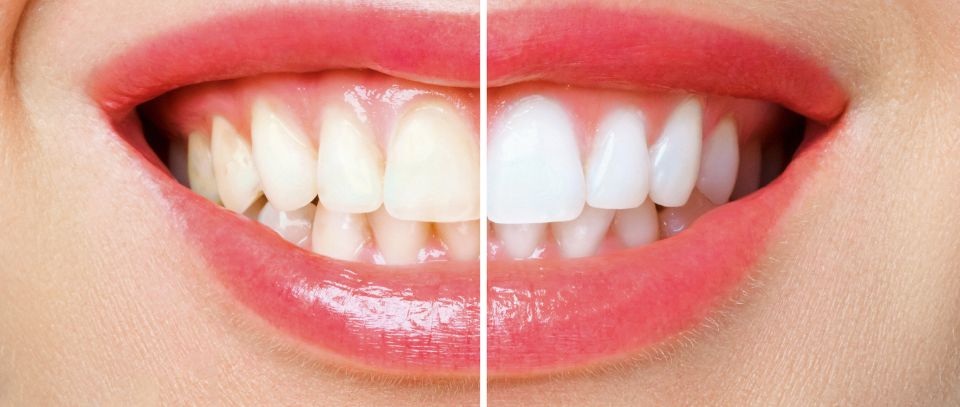 Mitos y realidades blanqueamiento dental