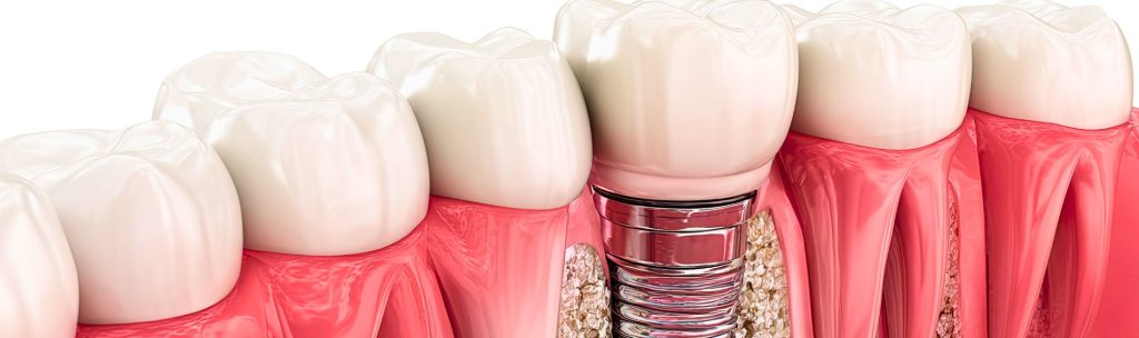 Can you get dental implants if you have little bone
