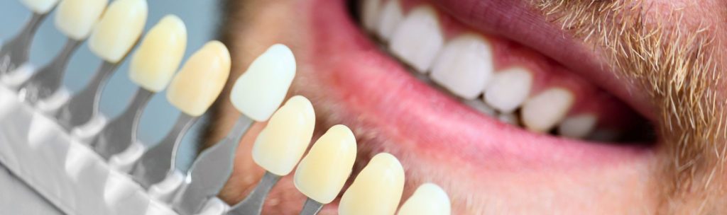How to care for your dental veneers