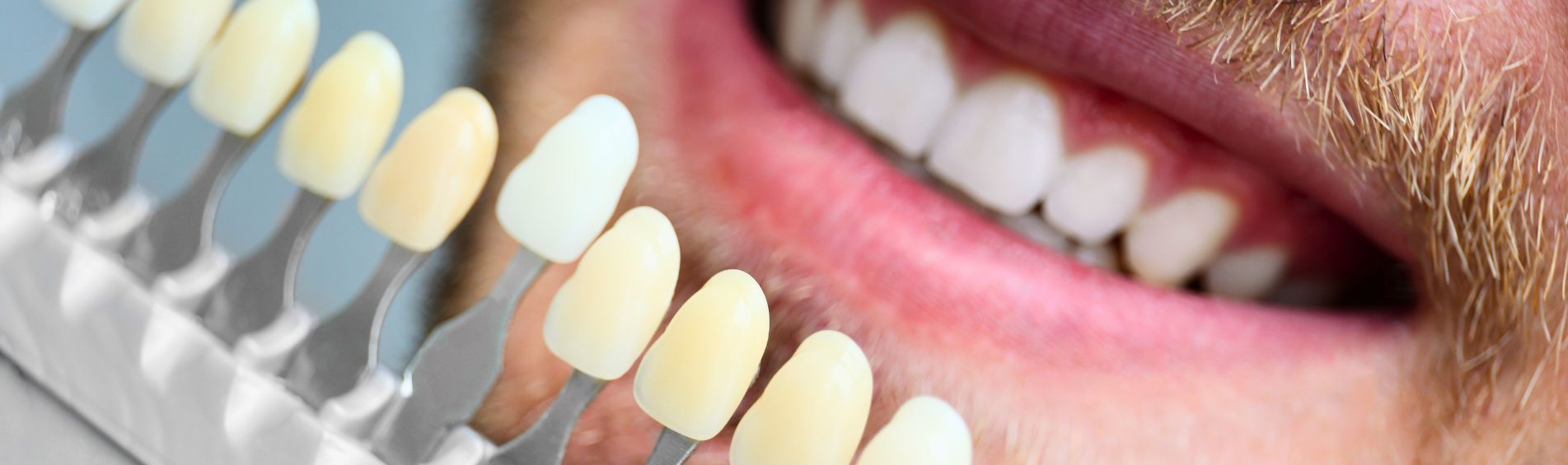 How to care for your dental veneers