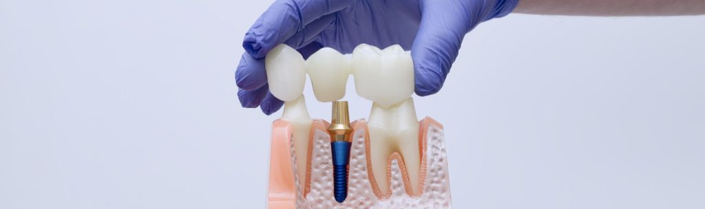 Cuidar implante dental
