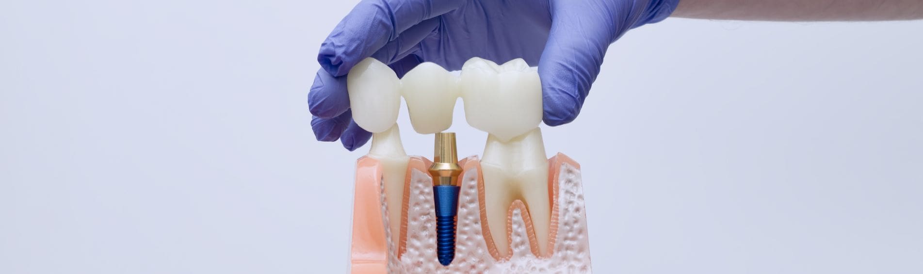 Cuidar implante dental